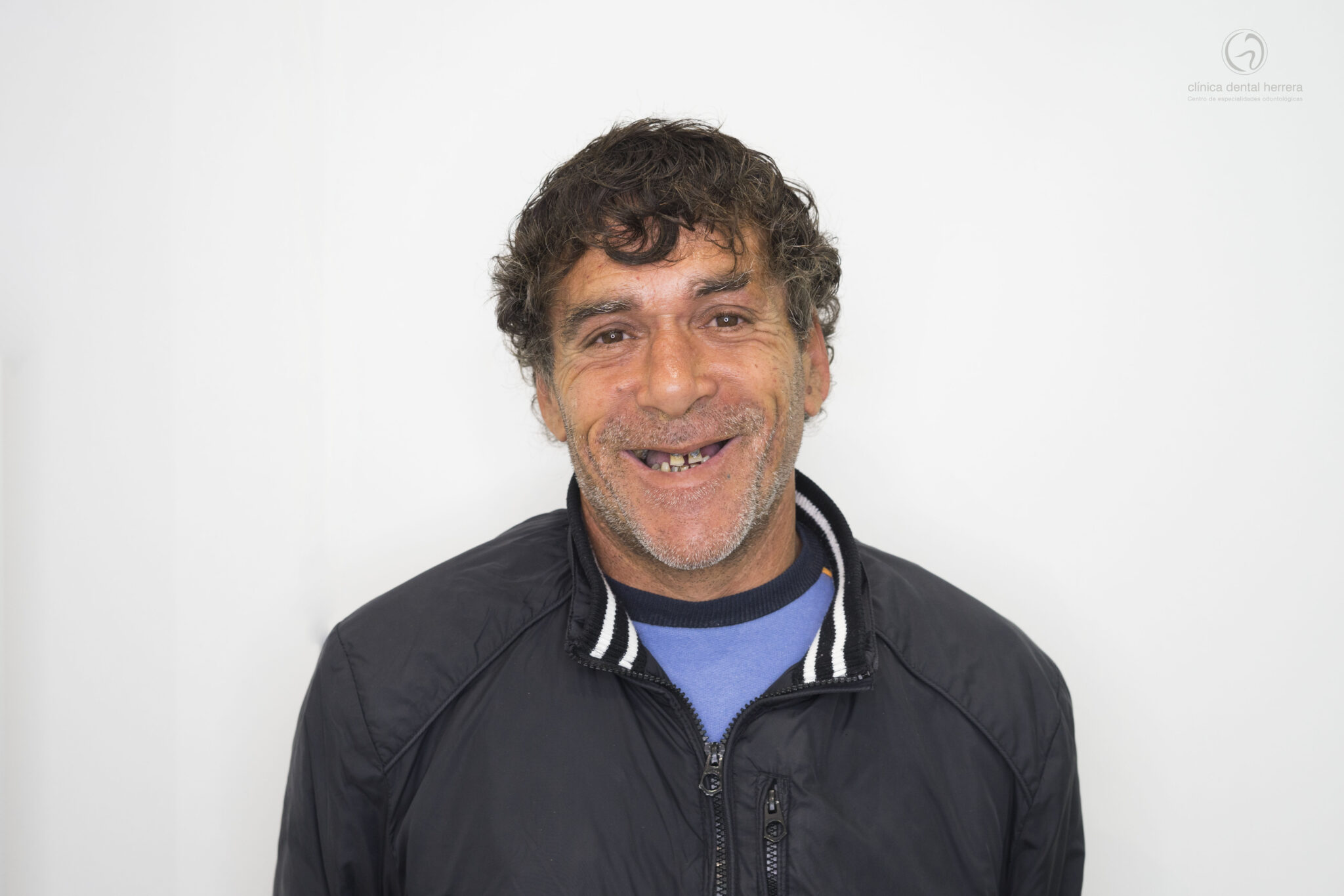Francisco. 6 Dental Implants in the Maxilla, 4 in the Mandible and 2 Overdentures 1 Before