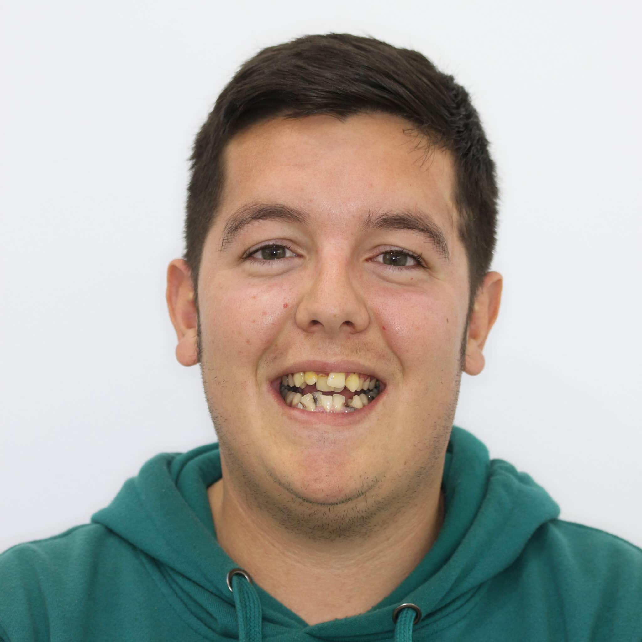 Francisco Díaz Aponte. Dental Reconstruction, Implants, Orthodontics and Dental Whitening 1 Before