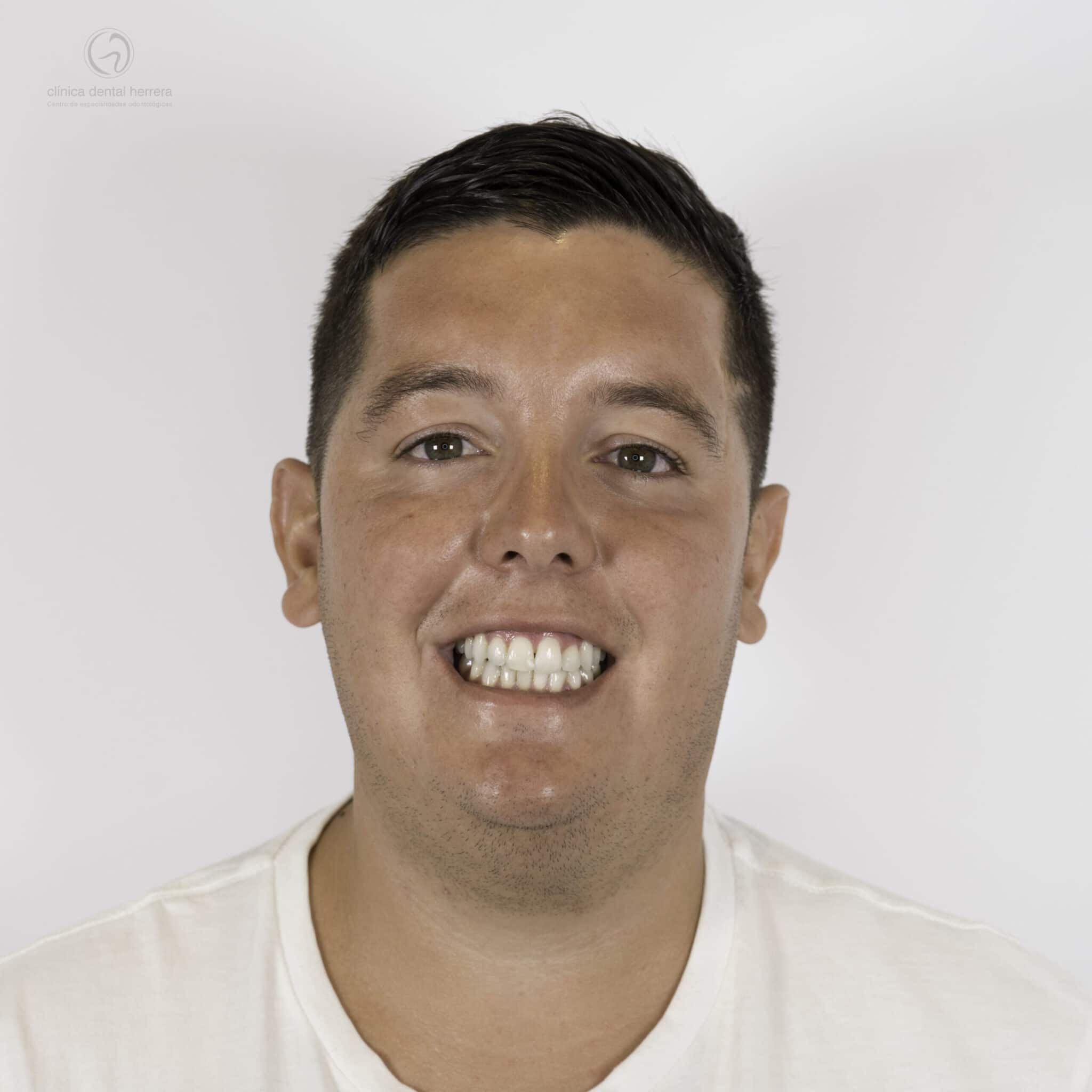 Francisco Díaz Aponte. Dental Reconstruction, Implants, Orthodontics and Dental Whitening 2 After