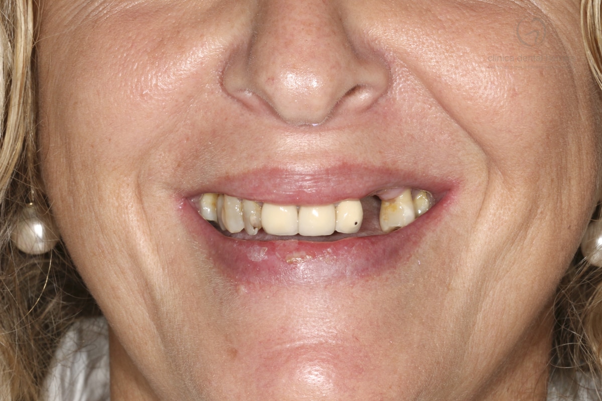 Maria Victoria Jiménez. 7 Dental Implants and Crowns 1 Before