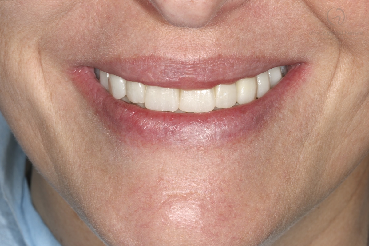 Maria Victoria Jiménez. 7 Dental Implants and Crowns 2 After