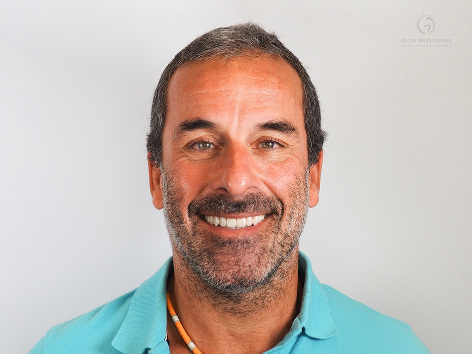 Antonio Díaz Ortega. Invisalign, Veneers and Dental Crowns 2 After