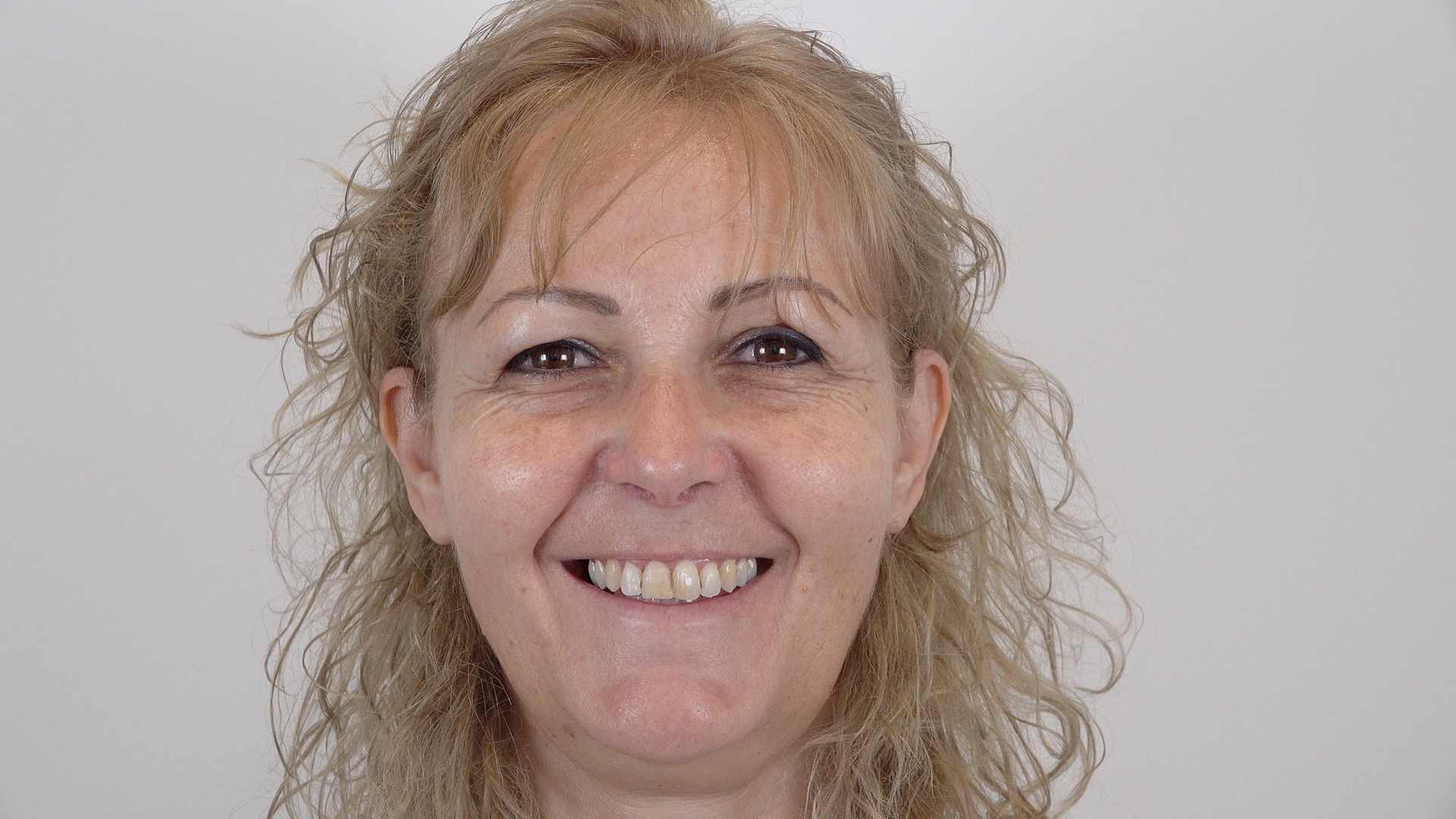 Dolores Martín Castillo. Invisalign and Dental Veneers 1 Antes