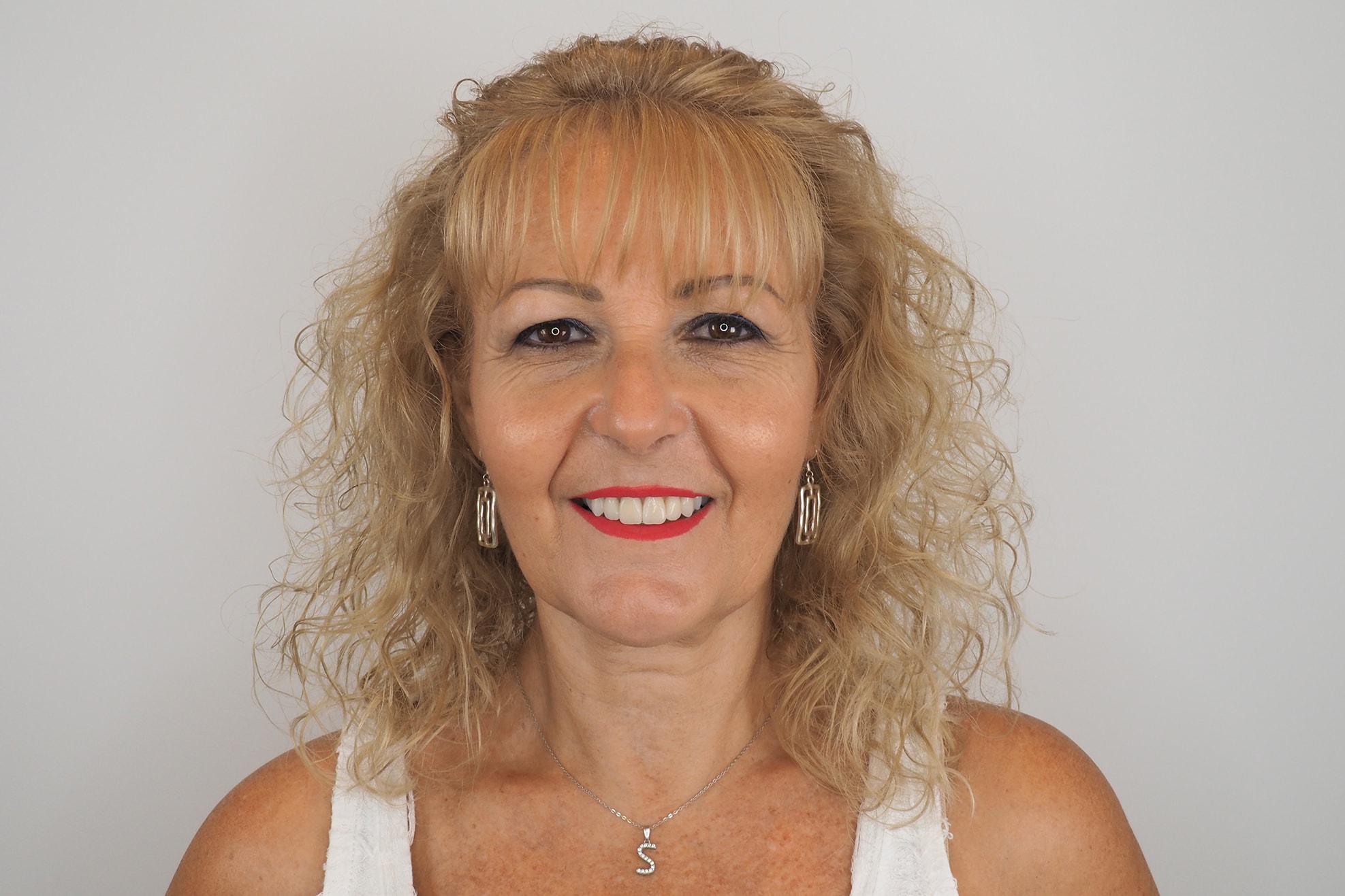 Dolores Martín Castillo. Invisalign and Dental Veneers 2 Después