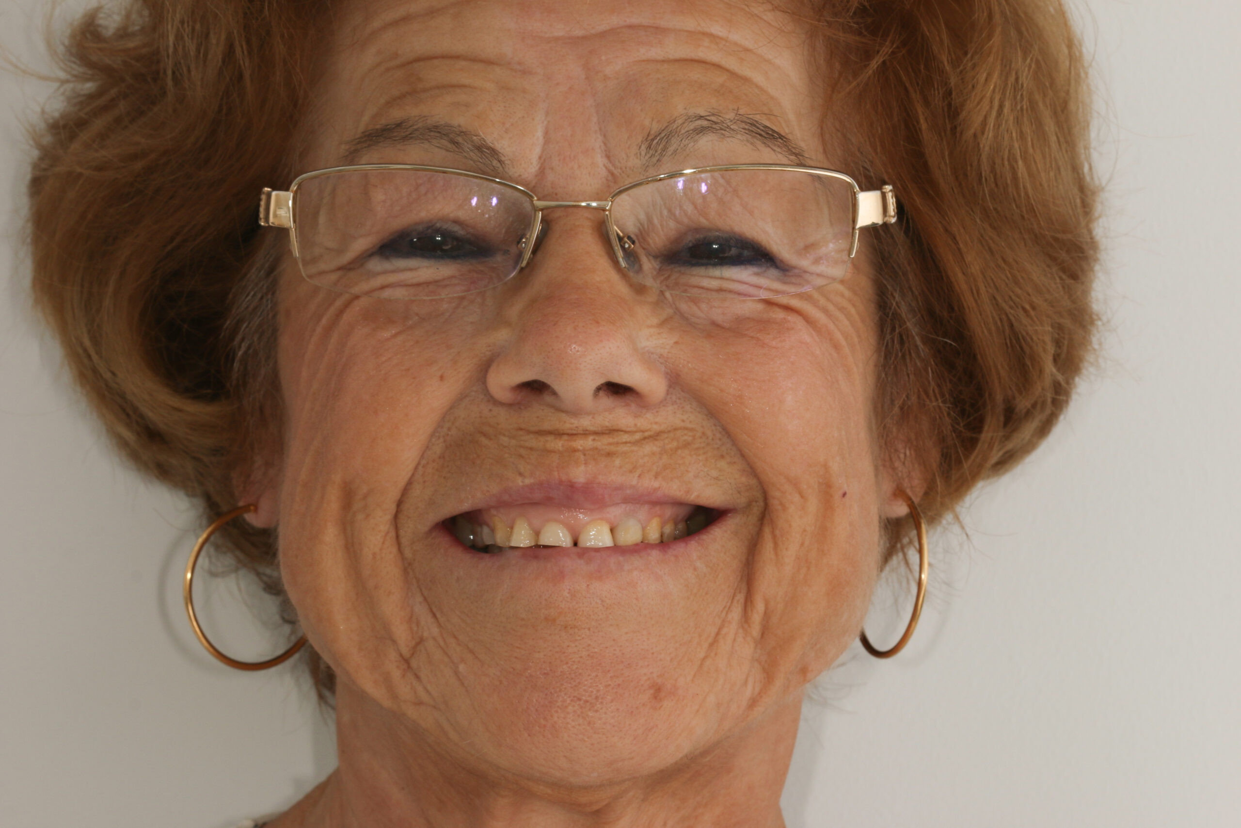 Socorro Padilla Marín: Complete oral rehabilitation: crowns on implants and crowns on teeth 1 Antes