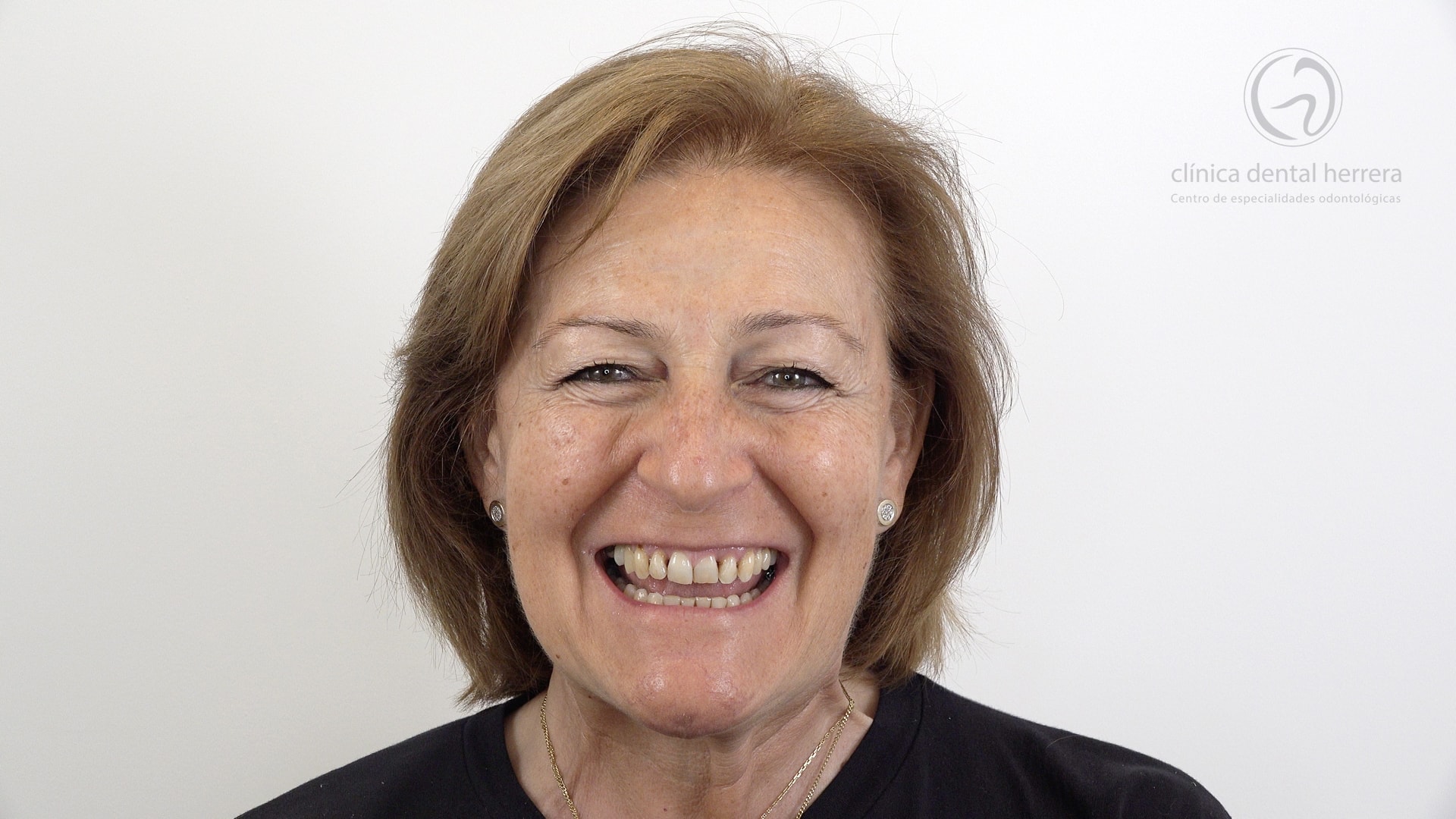 Inmaculada García-Chicano. Orthodontics, Implants and Dental Veneers 1 Before